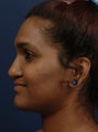 Rhinoplasty