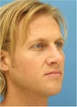Rhinoplasty