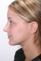 Rhinoplasty