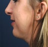 Rhinoplasty