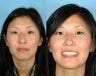 Rhinoplasty