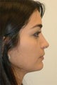 Rhinoplasty
