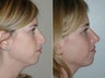 Rhinoplasty
