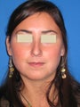 Rhinoplasty