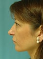 Rhinoplasty