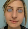 Rhinoplasty