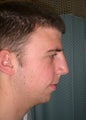 Rhinoplasty
