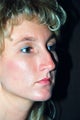 Rhinoplasty