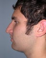 Rhinoplasty