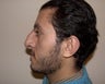 Rhinoplasty