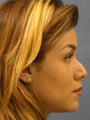 Rhinoplasty