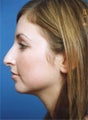 Rhinoplasty
