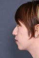 Rhinoplasty