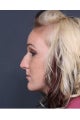 Rhinoplasty