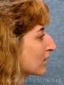 Rhinoplasty