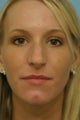 Rhinoplasty