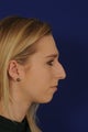Rhinoplasty