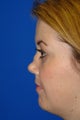 Rhinoplasty