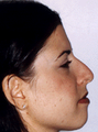 Rhinoplasty