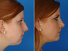 Rhinoplasty