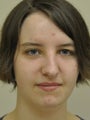 Rhinoplasty