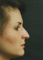 Rhinoplasty