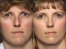 Rhinoplasty