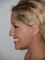 Rhinoplasty