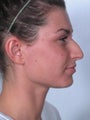 Rhinoplasty
