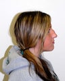 Rhinoplasty