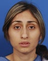Rhinoplasty