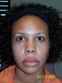 African American Rhinoplasty