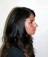Rhinoplasty