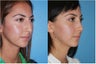 Rhinoplasty