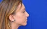 Rhinoplasty