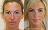 Rhinoplasty