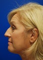 Rhinoplasty