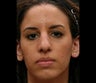 Rhinoplasty