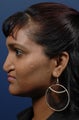 Rhinoplasty