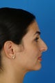 Rhinoplasty