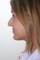 Rhinoplasty