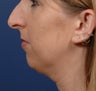 Rhinoplasty