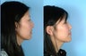 Rhinoplasty