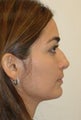 Rhinoplasty