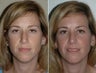 Rhinoplasty