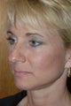 Rhinoplasty