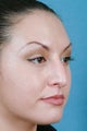 Rhinoplasty