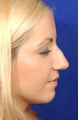 Rhinoplasty