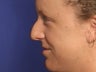 Rhinoplasty