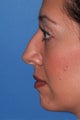 Rhinoplasty